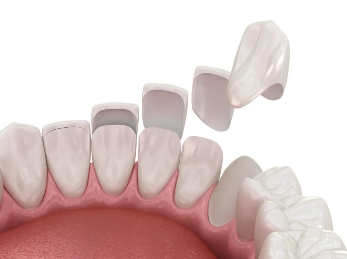 veneers